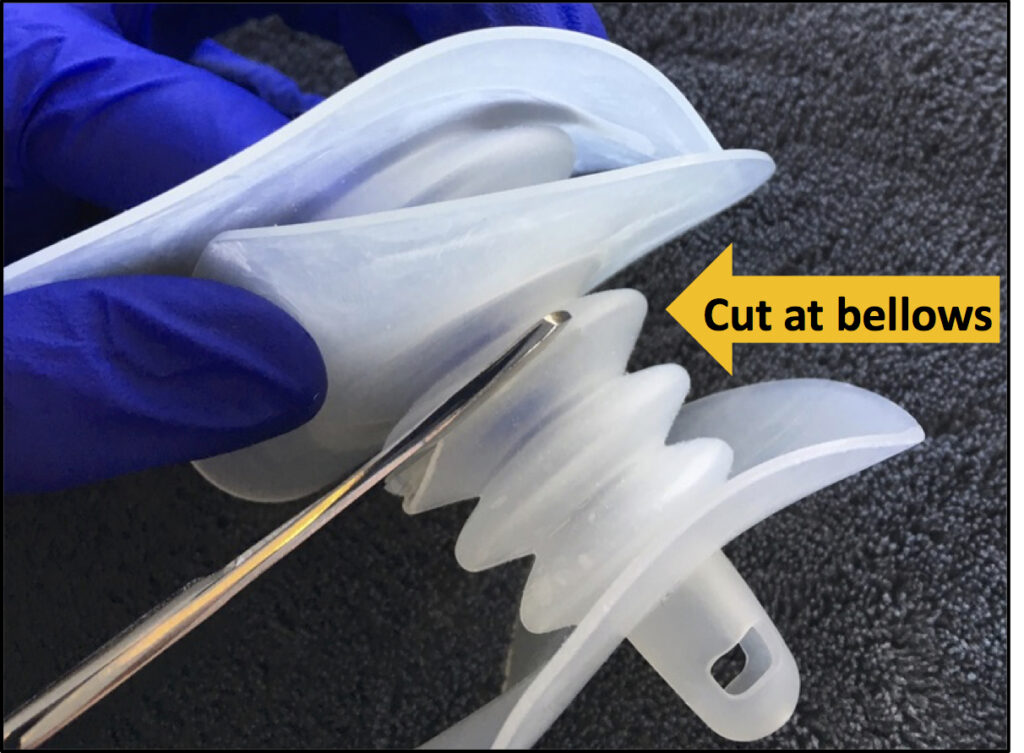 Belted Pouching with Fistula Solution Devices Fistula Solution