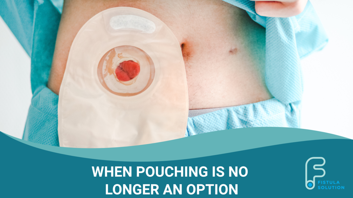 When Pouching Is No Longer an Option in Complex Ostomy and Fistula Cases