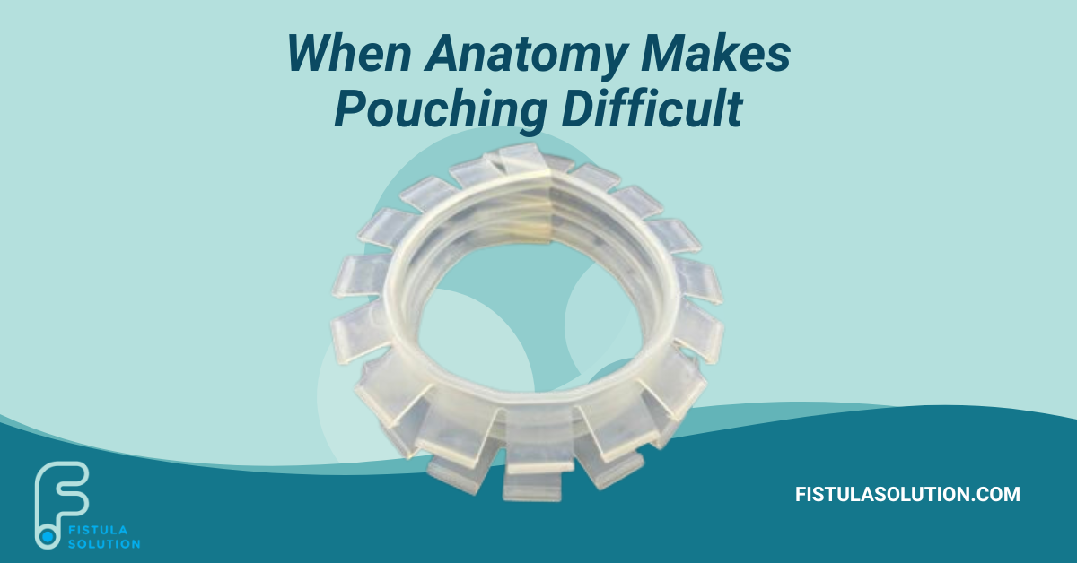 When Anatomy Makes Pouching Difficult