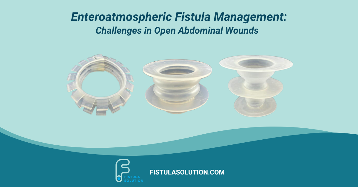 Fistula Solution Wound Crown, Fistula Funnel, and Isolator Strip devices featured in an enteroatmospheric fistula management graphic